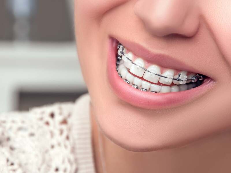 builder Post Follow us Retrait des appareils orthodontiques - Centre dentaire Pierrelaye