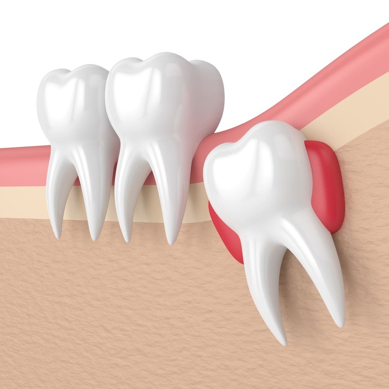 chirurgie orale - extraction dents de sagesse